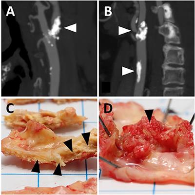 Warfarin Treatment Is Associated to Increased Internal Carotid Artery Calcification